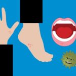 ‘웬 물집이?’ 혹시 우리 아이도 수족구병?